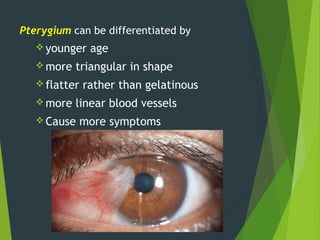 Pterygium can be differentiated by
 younger age
 more triangular in shape
 flatter rather than gelatinous
 more linear blood vessels
 Cause more symptoms
 