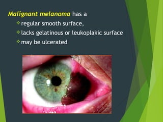 Malignant melanoma has a
 regular smooth surface,
 lacks gelatinous or leukoplakic surface
 may be ulcerated
 