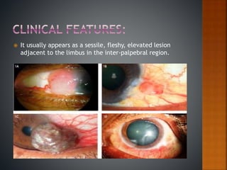  It usually appears as a sessile, fleshy, elevated lesion
adjacent to the limbus in the inter-palpebral region.
 