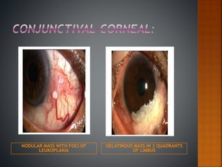 NODULAR MASS WITH FOCI OF
LEUKOPLAKIA
GELATINOUS MASS IN 2 QUADRANTS
OF LIMBUS
 