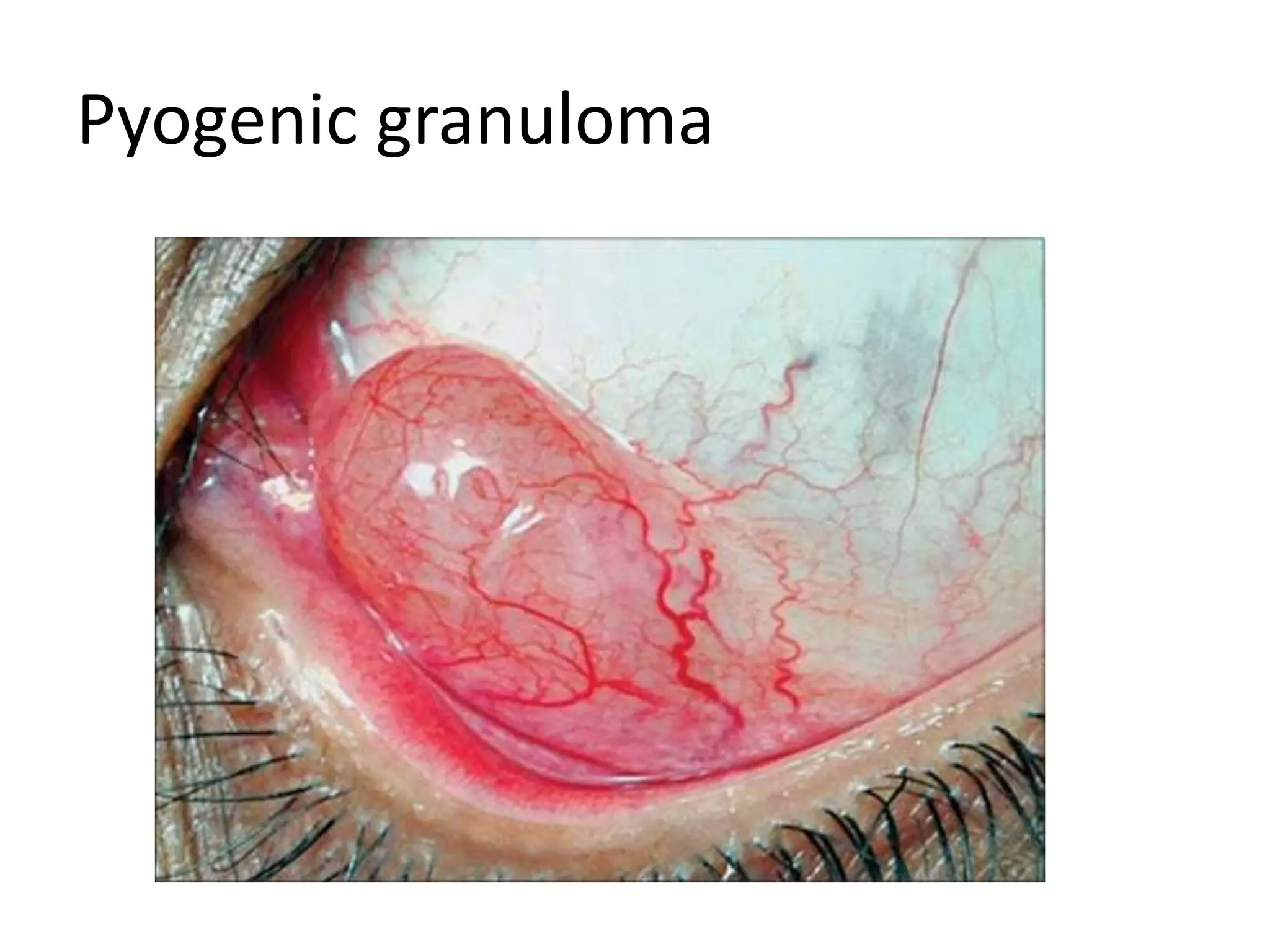 Pyogenic granuloma
 