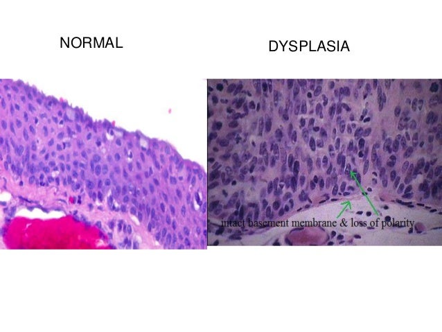 Ocular surface squamous neoplasiaa.ppt1 Ocular surface squamous neoplasiaa.ppt1