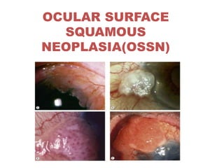 OCULAR SURFACE
SQUAMOUS
NEOPLASIA(OSSN)
 