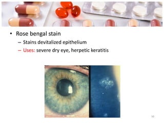 Rose bengal stain Stains devitalized epithelium Uses:  severe dry eye, herpetic keratitis 