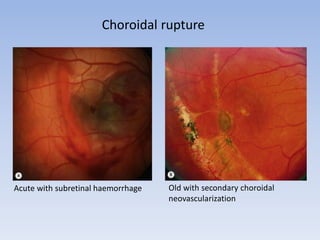 oculartrauma-140917145547-phpapp01.pdf