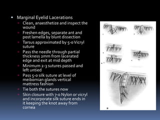  Marginal Eyelid Lacerations
 Clean, anaesthetize and inspect the
wound
 Freshen edges, separate ant and
post lamella by blunt dissection
 Tarsus approximated by 5-0Vicryl
suture
 Pass the needle through partial
thickness 2mm from lacerated
edge and exit at mid depth
 Minimum 2-3 sutures passed and
left untied
 Pass 5-0 silk suture at level of
meibomian glands vertical
mattress fashion
 Tie both the sutures now
 Skin closure with 7-0 Nylon or vicryl
and incorporate silk suture ends in
it keeping the knot away from
cornea
 