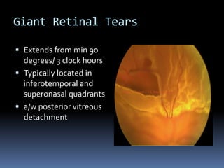 Giant Retinal Tears
 Extends from min 90
degrees/ 3 clock hours
 Typically located in
inferotemporal and
superonasal quadrants
 a/w posterior vitreous
detachment
 