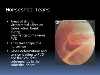 Horseshoe Tears
 Areas of strong
vitreoretinal adhesion
cause retinal break
during
traumatic/spontaneous
PVD
 They take shape of a
horseshoe
 Globe deformations and
torsion leading to PVD
and fluid collects
subsequently in the
subretinal space
 