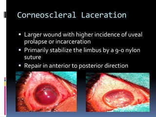 Corneoscleral Laceration
 Larger wound with higher incidence of uveal
prolapse or incarceration
 Primarily stabilize the limbus by a 9-0 nylon
suture
 Repair in anterior to posterior direction
 