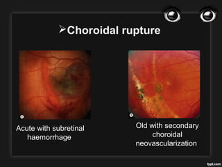Ocular trauma | PPT
