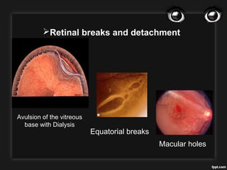 Operculated Break Ocular trauma | PPT