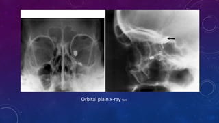 Orbital plain x-ray Net
 