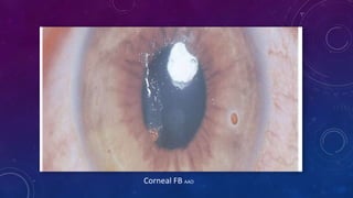 Corneal FB AAO
 
