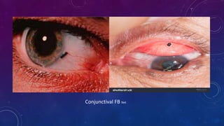Conjunctival FB Net
 