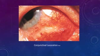 Conjunctival Laceration Net
 