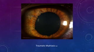 Traumatic Mydriasis Net
 