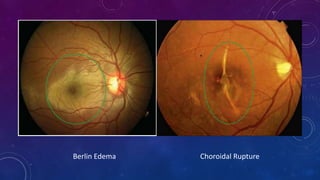 Berlin Edema Choroidal Rupture
 