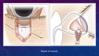 Repair of wound
 
