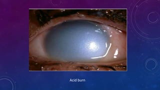 Acid burn
 