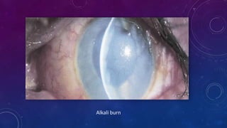 Alkali burn
 