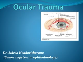 Dr .Sidesh Hendavitharana
(Senior registrar in ophthalmology)
 