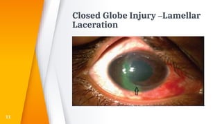 Closed Globe Injury –Lamellar
Laceration
11
 