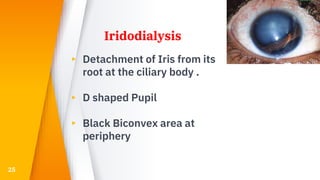 Iridodialysis
▸ Detachment of Iris from its
root at the ciliary body .
▸ D shaped Pupil
▸ Black Biconvex area at
periphery
25
 