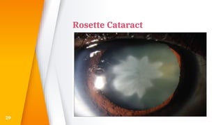 Rosette Cataract
29
 