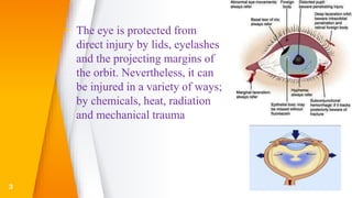 ▸ The eye is protected from
direct injury by lids, eyelashes
and the projecting margins of
the orbit. Nevertheless, it can
be injured in a variety of ways;
by chemicals, heat, radiation
and mechanical trauma
3
 
