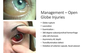Ocular Trauma/ trauma to eye. .pptx