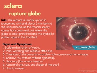 Ocular trauma ..effect on cornea and sclera | PDF