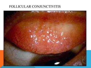 FOLLICULAR CONJUNCTIVITIS 
 