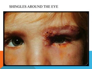 SHINGLES AROUND THE EYE 
 