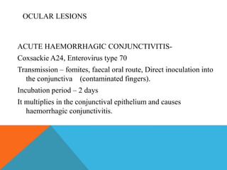 OCULAR LESIONS 
ACUTE HAEMORRHAGIC CONJUNCTIVITIS-Coxsackie 
A24, Enterovirus type 70 
Transmission – fomites, faecal oral route, Direct inoculation into 
the conjunctiva (contaminated fingers). 
Incubation period – 2 days 
It multiplies in the conjunctival epithelium and causes 
haemorrhagic conjunctivitis. 
 