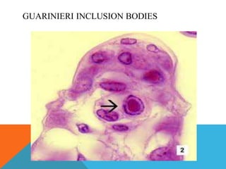 GUARINIERI INCLUSION BODIES 
 