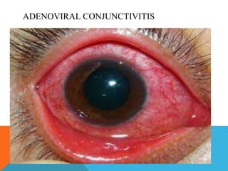 ADENOVIRAL CONJUNCTIVITIS 
 