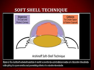 Ocular viscoelastic devices(OVD) | PPTX