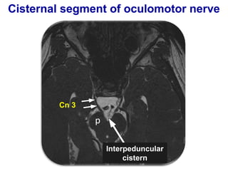 Cisternal segment of oculomotor nerve
Cn 3
Interpeduncular
cistern
 