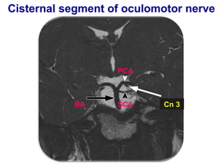 Cisternal segment of oculomotor nerve
BA Cn 3SCA
PCA
 