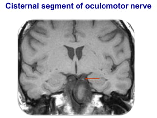 Cisternal segment of oculomotor nerve
 