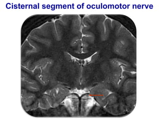 Cisternal segment of oculomotor nerve
 