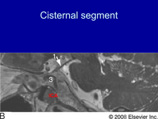 Cisternal segment
ICA
 