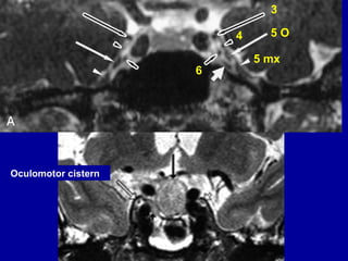 4 5 O
6
3
5 mx
Oculomotor cistern
 