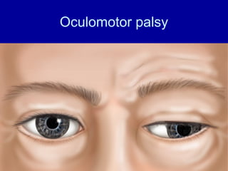 Oculomotor palsy
 
