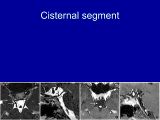 Cisternal segment
 