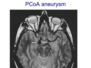 PCoA aneurysm
 