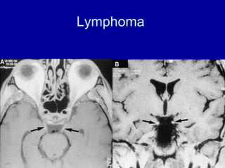 Lymphoma
 