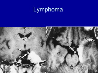 Lymphoma
 