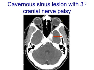 Cavernous sinus lesion with 3rd
cranial nerve palsy
 