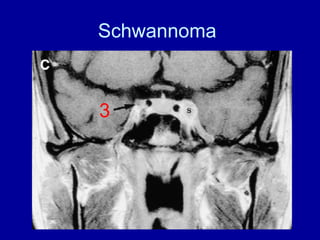 Schwannoma
3
 